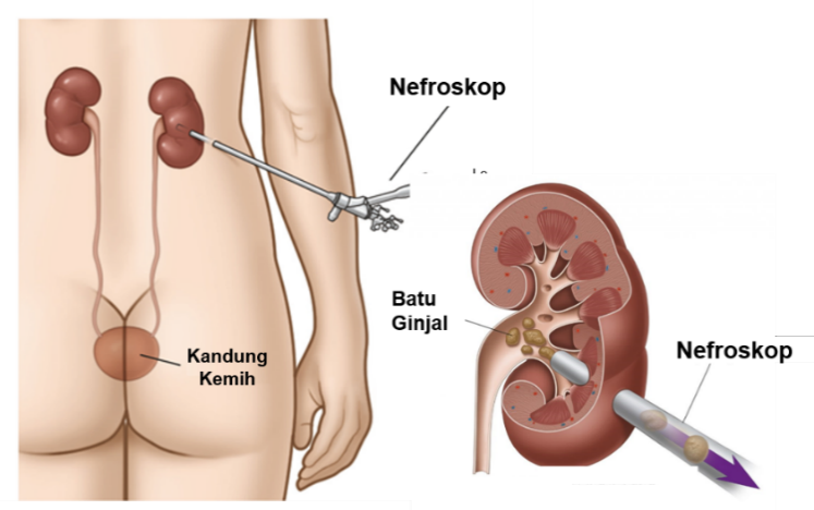 Nefrolitiasis adalah